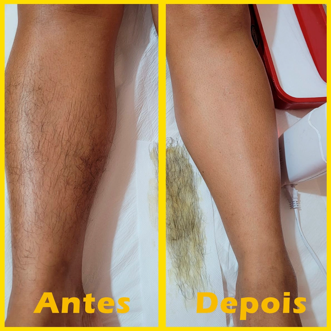 modelo-antes-depois1